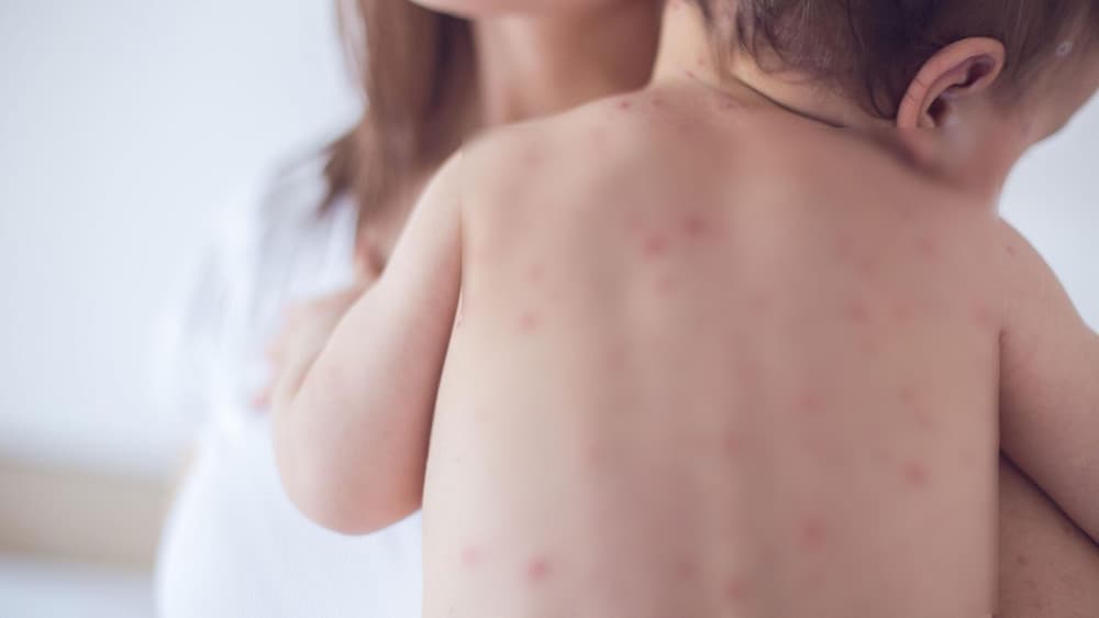 Улаанбурхан өвчний 11 тохиолдол нэмэгджээ